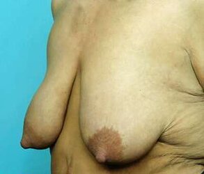 Deformed and saggy titts